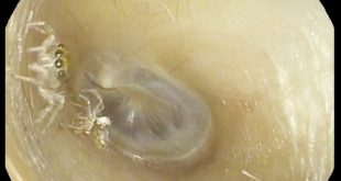 بیرون آوردن عنکبوت از یک گوش زن 64 ساله! + ویدیو