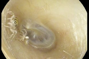 بیرون آوردن عنکبوت از یک گوش زن 64 ساله! + ویدیو