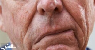 سالانه ۵۵۰ هزار ایرانی دچار سکته مغزی می‌شوند