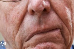 سالانه ۵۵۰ هزار ایرانی دچار سکته مغزی می‌شوند