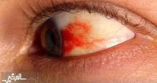 دو بیماری رتینوپاتی دیابتی و استحاله شبکیه بیماران دیابتی را تهدید می‌کند