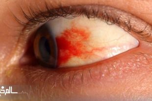 دو بیماری رتینوپاتی دیابتی و استحاله شبکیه بیماران دیابتی را تهدید می‌کند