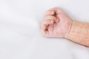 سرخک به طور هشدارآمیزی در اروپا در حال پیشروی است