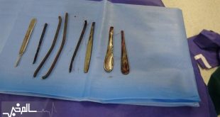 مرد شیشه‌ای ۴ دسته قاشق و ۴ شی فلزی دیگر را بلعید