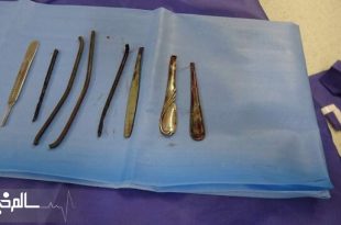 مرد شیشه‌ای ۴ دسته قاشق و ۴ شی فلزی دیگر را بلعید