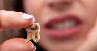 آمار فلاکت بی‌دندانی در ایرانی‌ها!