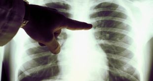 محققان یک قدم به درمان mRNA استنشاقی برای سرطان ریه نزدیک‌تر شدند