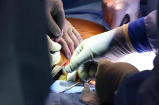 اولین بیمار دریافت‌کننده کلیه اصلاح‌شده خوک درگذشت