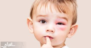  آلرژی یکی از بیماری‌های شایع کودکان است