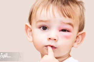  آلرژی یکی از بیماری‌های شایع کودکان است