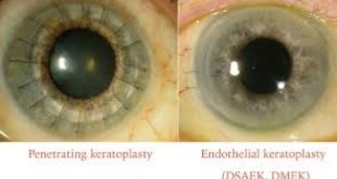 جایگزینی پزشکی قانونی به جای بانک چشم در بهشت زهرا دلیل معطلی زیاد در صف پیوند قرنیه