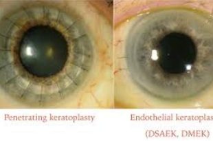 جایگزینی پزشکی قانونی به جای بانک چشم در بهشت زهرا دلیل معطلی زیاد در صف پیوند قرنیه