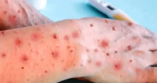 علائم آبله میمون