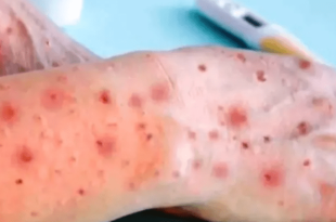 علائم آبله میمون