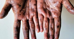 سازمان جهانی بهداشت آبله میمون را یک وضعیت اضطراری اعلام کرد