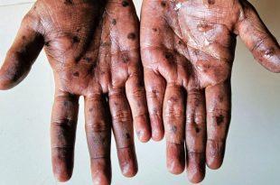 سازمان جهانی بهداشت آبله میمون را یک وضعیت اضطراری اعلام کرد