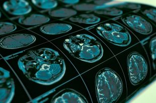 فناوری ژن‌درمانی جدید برای درمان پارکینسون