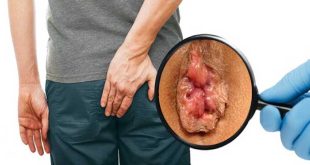 هزینه جراحی بواسیر با لیزر بررسی هزینه های مختلف