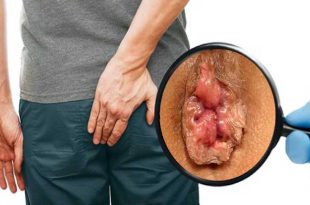 هزینه جراحی بواسیر با لیزر بررسی هزینه های مختلف