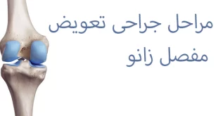 مراحل جراحی تعویض مفصل زانو