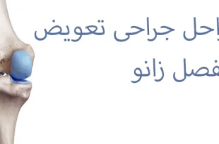 مراحل جراحی تعویض مفصل زانو