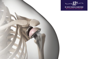 جراحی شانه: راهکار قطعی برای درمان درد و محدودیت حرکتی