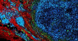 مبارزه با سرطان با پالس‌های الکتریکی با شدت کم