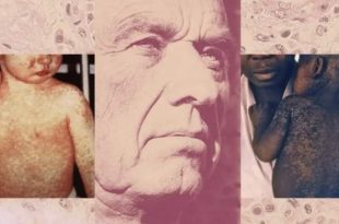 دستور دور از انتظار وزیر؛ به جای واکسیناسیون، دنبال روغن کبد ماهی بگردید!