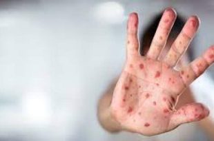 زنگ خطر شیوع «سرخک» به صدا در آمد