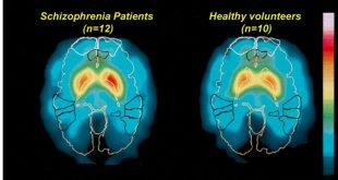 تشخیص دقیق اسکیزوفرنی با هوش مصنوعی BrainProbe در تایوان