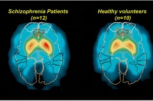 تشخیص دقیق اسکیزوفرنی با هوش مصنوعی BrainProbe در تایوان