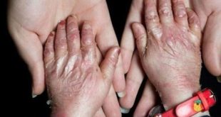 تجدید فراخوان تامین پانسمان‌های بیماران پروانه ای