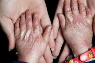 تجدید فراخوان تامین پانسمان‌های بیماران پروانه ای