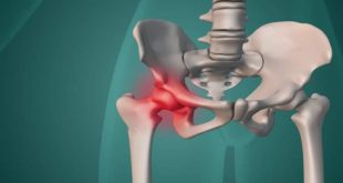 نادیده گرفتن درد ران و لگن منجر به آرتروز و جراحی تعویض مفصل منجر شود