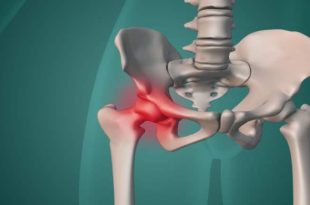 نادیده گرفتن درد ران و لگن منجر به آرتروز و جراحی تعویض مفصل منجر شود