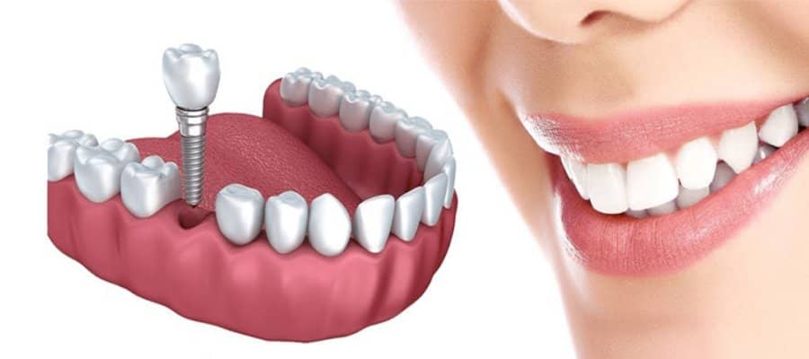 مراحل انجام ایمپلنت فوری دندان