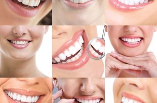 دندانپزشک زیبایی در کرج؛ قبل از اصلاح لبخند این نکات را بدانید