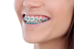 آیا ارتودنسی فقط جنبه زیبایی دارد؟ نگاهی به تأثیر این درمان بر سلامت دهان، فک و کیفیت زندگی