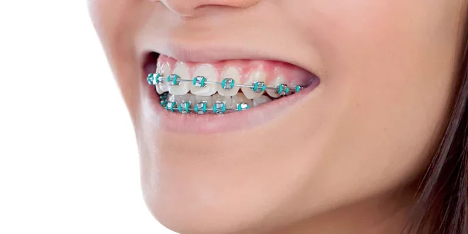 آیا ارتودنسی فقط جنبه زیبایی دارد؟ نگاهی به تأثیر این درمان بر سلامت دهان، فک و کیفیت زندگی